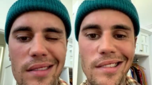 Justin Bieber Face paralysed
